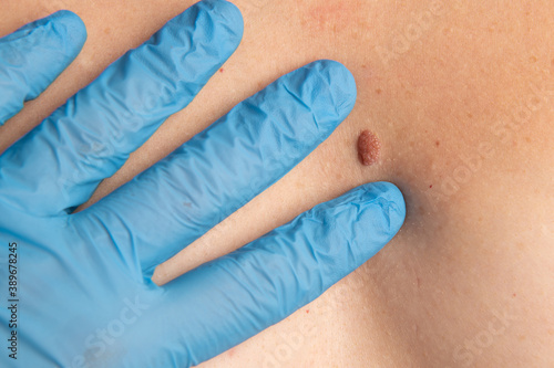 Checking up the mole on woman skin
