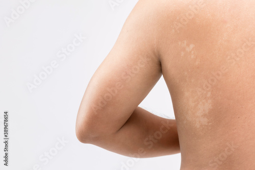 Macro white Pityriasis or Tinea Versicolor on back skin. Used for skincare concept photo