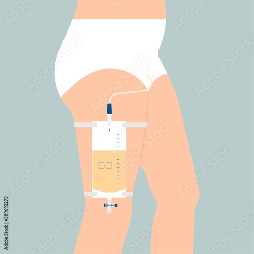 Urine bag medical treatment drainage bladder rubber flexible body infection bacteria output measure tract toilet leg relieve cancer device calculi vesical problem anatomy sterile surgical urethra