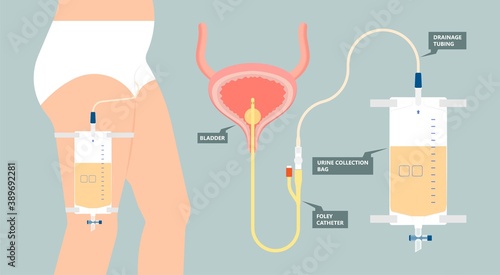 Urine bag medical treatment drainage bladder rubber flexible body infection bacteria output measure tract toilet leg relieve cancer device calculi vesical problem anatomy sterile surgical urethra photo