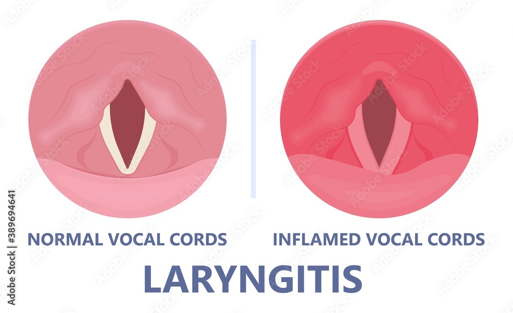 Sore loss cough virus viral acute swell sound folds treat cysts Palsy