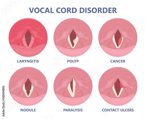 Sore loss cough virus viral acute swell sound folds treat cysts Palsy nerve Tumor botox throat hoarse larynx airway polyps Cancer injury speech
damage Ulcers box chronic nodules surgery reflux upper