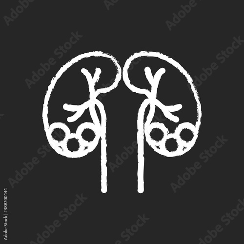 Kidney stone disease chalk white icon on black background. Dissolved minerals and salts. Urolithiasis. Blocked ureter. Waste products in blood. Isolated vector chalkboard illustration