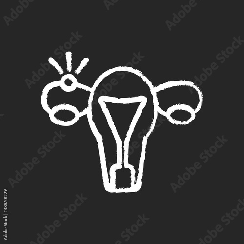 Ectopic pregnancy chalk white icon on black background. Fallopian tube. Embryo outside uterus. Tubal, extrauterine complication. Abdominal pain. Isolated vector chalkboard illustration