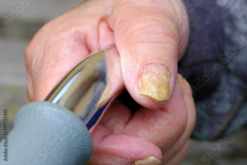 Fungal nail disease on the hands of an elderly person close up selective focus photo