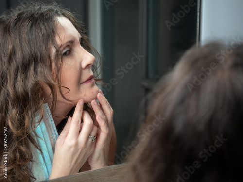 Caucasian middle - aged woman suffering from acne on her chin after wearing protective face mask.