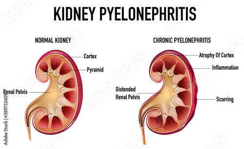 Informative illustration of Pyelonephritis