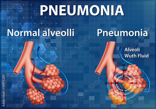 Comparison of healthy alveoli and Pneumonia