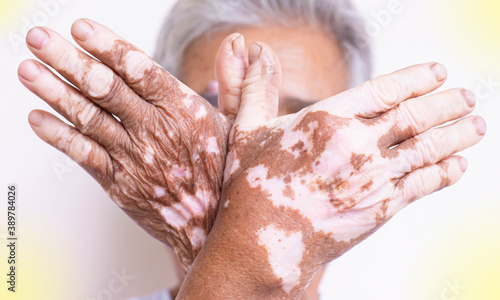 Vitiligo on the skin of a person, vitiligo on the hands or feet of the elderly, light fair