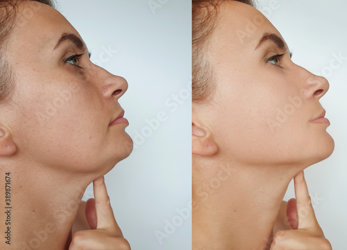 woman double chin before and after treatment photo