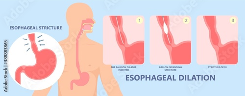 Dysphagia infection trachea examine Surgery choking gastric diagnose windpipe disorder bleeding surgical GERD treat tumor throat biopsy system ulcers stomach block eat food stuck test tract stent pain