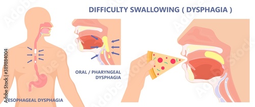 Dysphagia infection trachea examine Surgery choking gastric diagnose windpipe disorder bleeding surgical GERD treat tumor throat biopsy system ulcers stomach block eat food stuck test tract stent pain