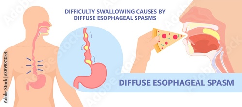Dysphagia infection trachea examine Surgery choking gastric diagnose windpipe disorder bleeding surgical GERD treat tumor throat biopsy system ulcers stomach block eat food stuck test tract stent pain