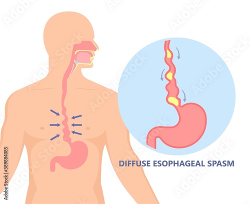 Dysphagia infection trachea examine Surgery choking gastric diagnose windpipe disorder bleeding surgical GERD treat tumor throat biopsy system ulcers stomach block eat food stuck test tract stent pain
