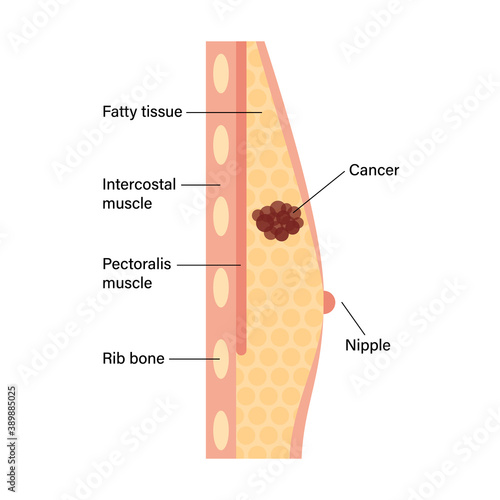 Breast disease concept