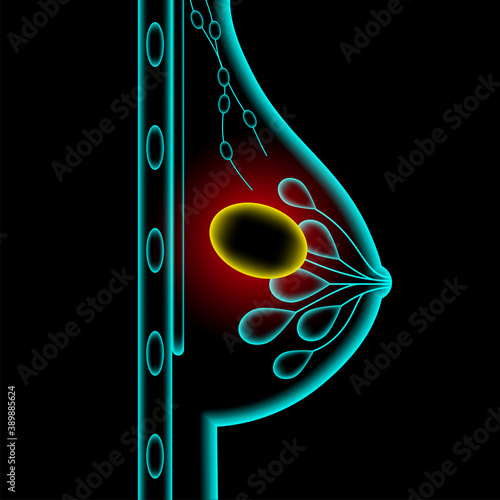 Breast disease concept