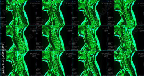 set of 6 sagittal green colored MRI scans of neck area of caucasian 34 years old male with bilateral paramedial extrusion of the C6-C7 segment