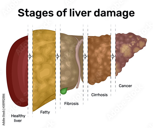 Illustration of the progression of liver disease from fatty liver to cancer photo