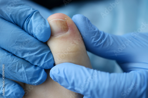 Doctor's hands in rubber gloves touch injured toenail in clinic closeup. Diagnosis and treatment of mycosis of feet concept.