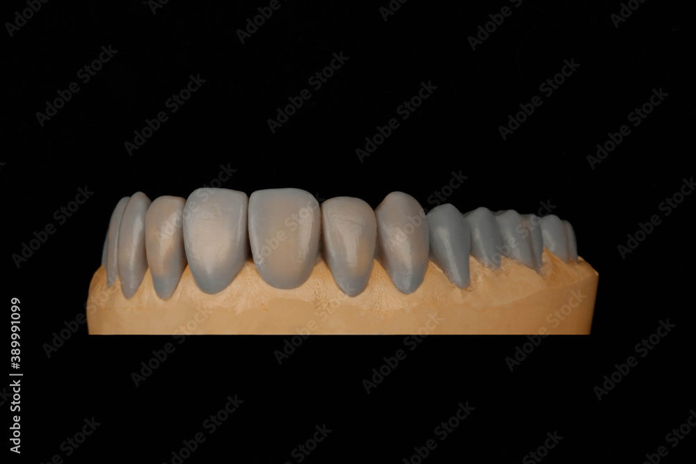 veneers wax-up design veneers wax-up design