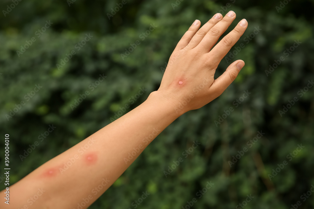 Woman with insect bites on arm in park, closeup Woman with insect bites on arm in park, closeup