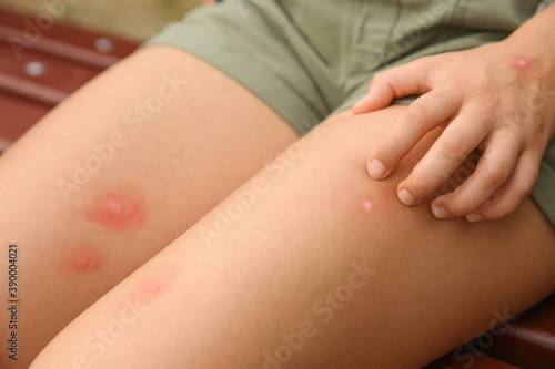 Woman scratching leg with insect bite outdoors, closeup