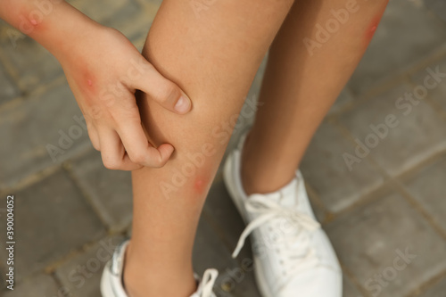 Girl scratching leg with insect bite outdoors, closeup