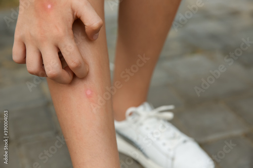 Fototapeta Naklejka Na Ścianę i Meble -  Girl scratching leg with insect bite outdoors, closeup