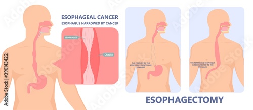 Dysphagia infection trachea examine Surgery choking gastric symptoms diagnose windpipe disorder bleeding surgical GERD treat tumor throat biopsy system ulcers stomach blocked eating food stuck test