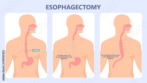 Dysphagia infection trachea examine Surgery choking gastric symptoms diagnose windpipe disorder bleeding surgical GERD treat tumor throat biopsy system ulcers stomach blocked eating food stuck test