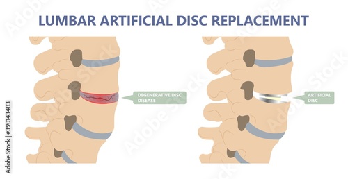 Artificial Disc for Treatment the Degenerative Disc Disease arthritis osteoarthritis spondylosis ankylosing spondylitis slipped