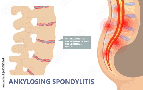Ankylosing Spondylitis osteoporosis Skeletal pelvis Stiffness chronic knee ankle spondylolysis