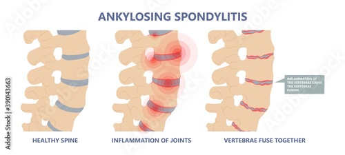 Ankylosing Spondylitis osteoporosis Skeletal pelvis Stiffness chronic knee ankle spondylolysis