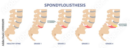Spondylolisthesis a spinal disease that causes one of the lower vertebrae to slip forward disk hip pain bone birth defect injury sports accident exam nerve epidural steroid injections fusion leg photo
