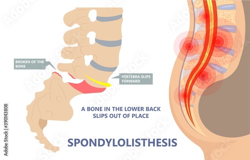 Spondylolisthesis a spinal disease that causes one of the lower vertebrae to slip forward disk hip pain bone birth defect injury sports accident exam nerve epidural steroid injections fusion leg