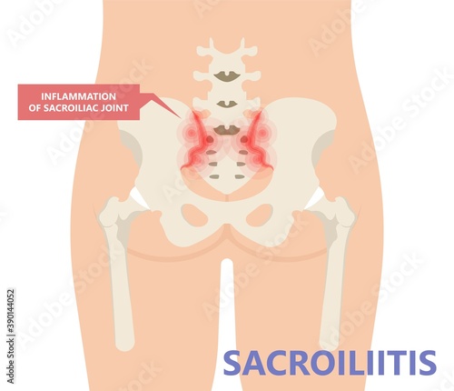 Sacroiliitis pain of sacroiliac joints and hips lupus legs physical exam ulcerative colitis infection swelling ligaments breakdown psoriasis Trauma Obesity Gout