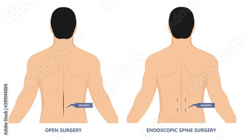 Endoscopic spine surgery micro facet syndrome Bone spurs joint Leg incisions tubular retractor  canal vertebrae Fractured  foraminotomy microforaminotomy microlaminectomy microlaminotomy Disorder