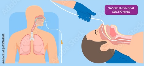 Suction adult nares unit lung clear fluid tube nose nasal pump treat nurse airway clinic device portable mucus oxygen emergency examination therapy sick anaesthetist pharynx pneumonia ventilation