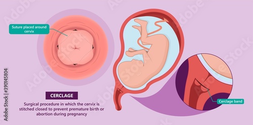 Incompetent cervix cervical insufficiency weak tissue premature stitch preterm miscarriage recurrent 