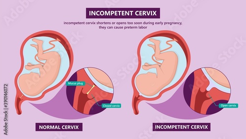 Incompetent cervix cervical insufficiency weak tissue premature stitch preterm miscarriage recurrent 