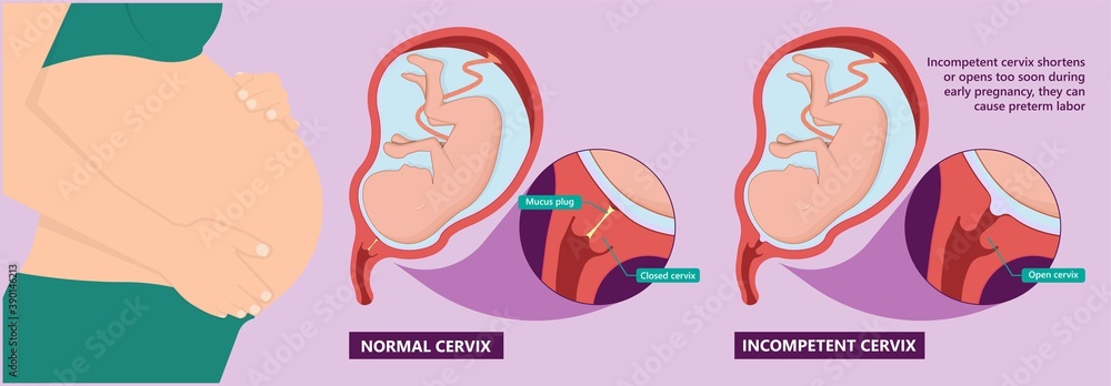 Incompetent cervix cervical insufficiency weak tissue premature stitch preterm miscarriage recurrent 
