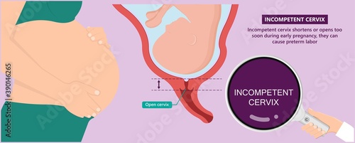Incompetent cervix cervical insufficiency weak tissue premature stitch preterm miscarriage recurrent 