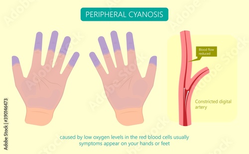 Peripheral cyanosis symptoms of low oxygen levels in the red blood cells raynaud finger feet Cold cyan color toes palms bluey green pain white vessels narrow Low Vein Heart failure Deep nervous