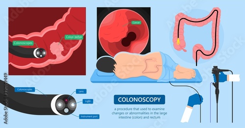 Polypectomy procedure to remove polyps from the colon medical