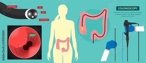 Polypectomy procedure to remove polyps from the colon medical