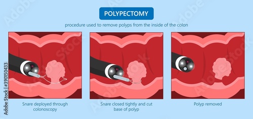 Polypectomy procedure to remove polyps from the colon medical