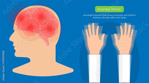 Essential tremor Deep brain stimulation DBS surgery device implant nerve uncontrollable arms head voice disability abnormal electrical controls muscle activity elderly Balance problem parkinson's
