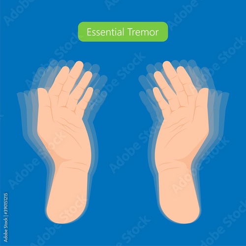 Essential tremor Deep brain stimulation DBS surgery device implant nerve uncontrollable arms head voice disability abnormal electrical controls muscle activity elderly Balance problem parkinson's