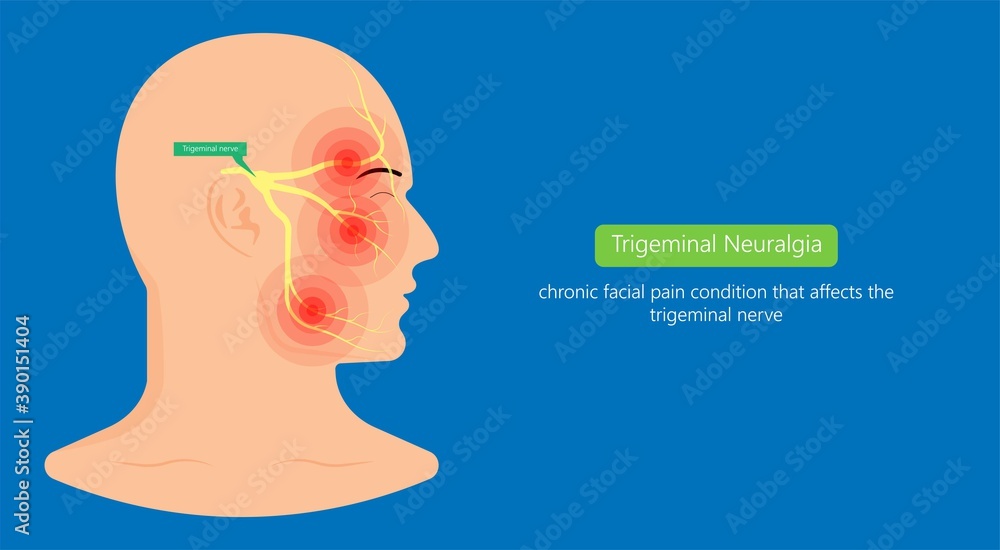 Trigeminal neuralgia chronic pain of facial TMD injury ophthalmic ...