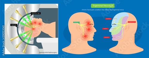 Trigeminal neuralgia chronic pain of facial TMD injury ophthalmic maxillary mandibular sensation central nervous system immune attacks myelin